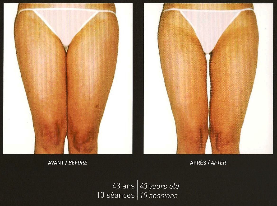 Prix D une Séance De Lpg Chez Kiné LPG Femme Cellu M6 Soins minceur traitement anti-cellulite Montpellier –  Centre kiné montpellier – bruno bernard masseur kinésithérapeute,  hypnothérapeute, sexothérapeute – kinésithérapie, rééducation, hypnose,  sexologie, massages relaxants, lpg cellu ...
